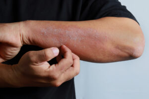 Man scratching rash on his hand