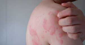 Woman scratching hives on her shoulder